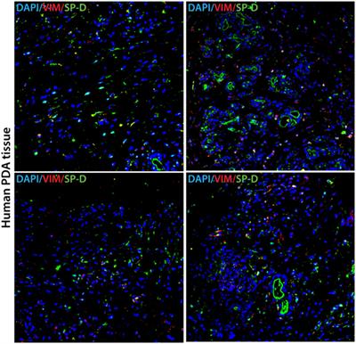 Human Surfactant Protein D Suppresses Epithelial-to-Mesenchymal Transition in Pancreatic Cancer Cells by Downregulating TGF-β